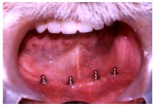 Mandibular Overdenture with MIB implants
