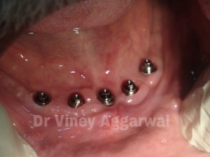 Multi Unit Abutments attached to Implants