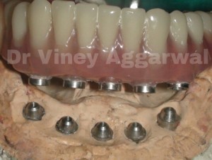 Hybrid Denture to fit over Implants with screws