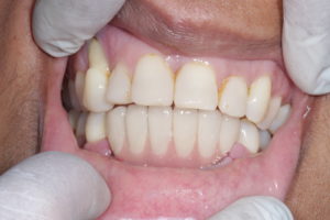 Lower Front Teeth
