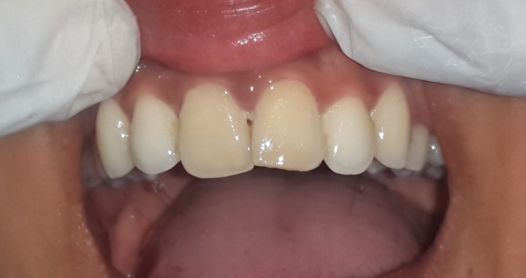 Upper Front Teeth
