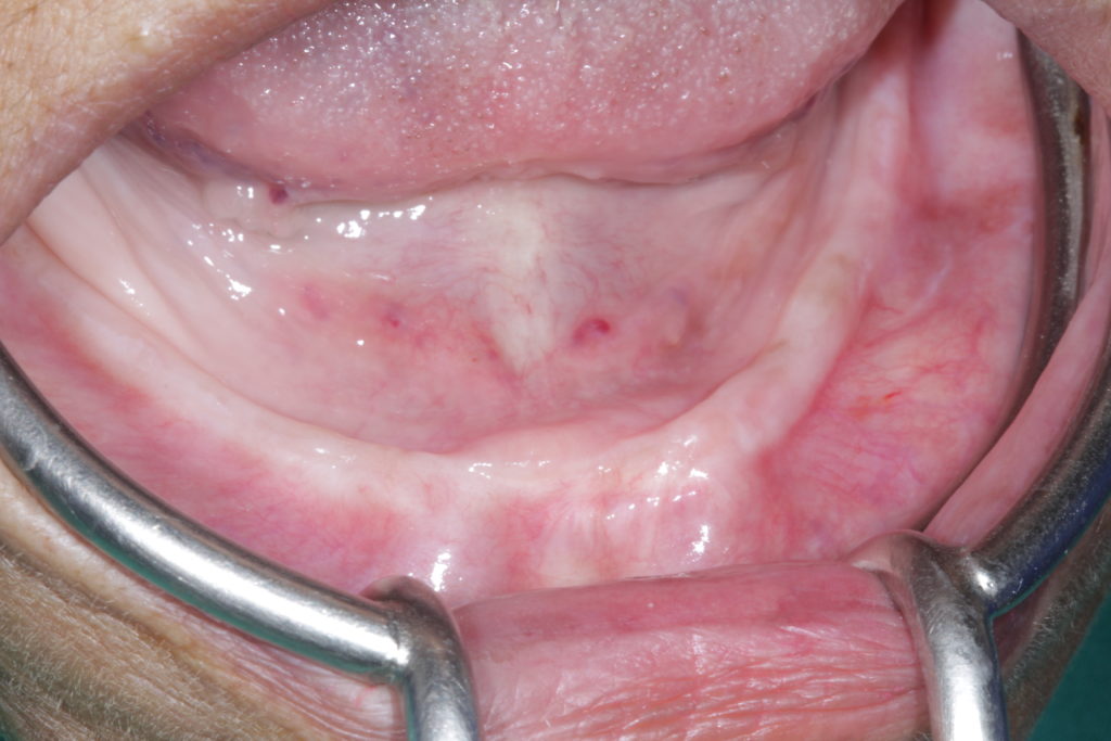 Thin Ridge unable to support dentures